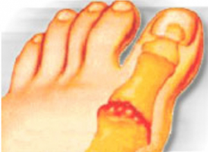 beweeglijkheid hallux